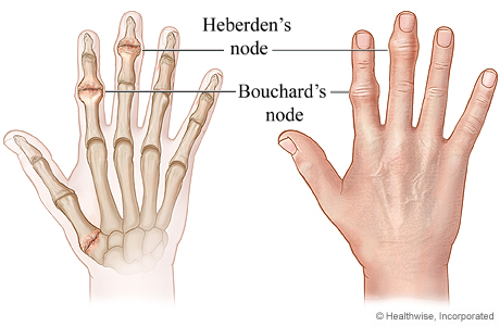 Thoái hóa khớp bàn tay: Nguyên nhân, dấu hiệu và cách chữa trị
